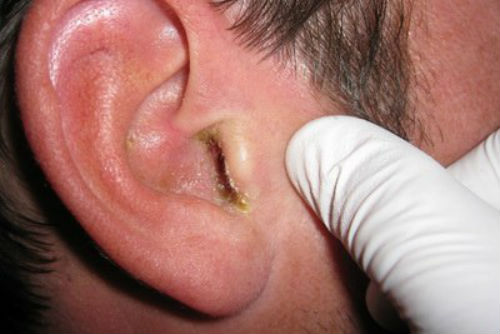 Псориаз в ушах, лечение